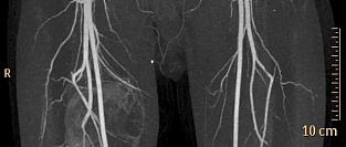 Рекомендации ESC/ ESVS по заболеваниям периферических артерий 2017