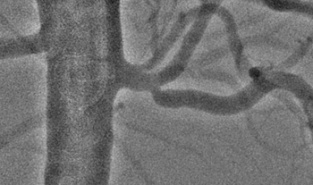 Бифуркационное стентирование почечной артерии