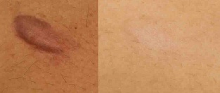 Лечение рубцов. Протокол ASAP. Часть 1