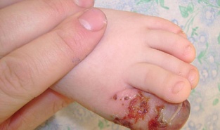 Герпетический панариций. Десятый день болезни