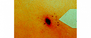 Лихорадка цуцугамуши