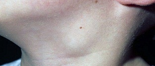 Подход к терапии острых шейных лимфаденитов у детей