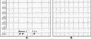 Аблация фибрилляции предсердий при дисфункции левого желудочка. Влияние на смертность 