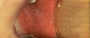 Корь. Влияние на иммунитет