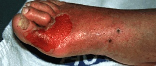 Осложнения сахарного диабета