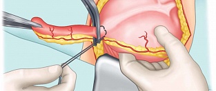 Выжидательная тактика при аппендиците и риск перфораций