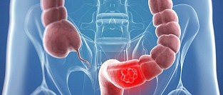 Скрининг колоректального рака. Альтернатива колоноскопии