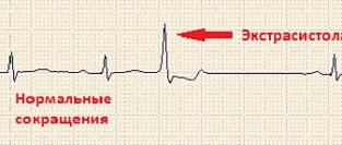 Экстрасистолия. Информация для пациентов.