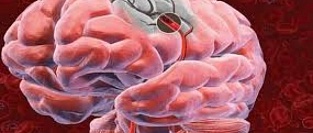 Тромболизис при инсульте. AHA/ASA расширяет показания