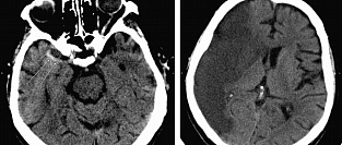 Ишемический инсульт. Об эффективности инвазивного лечения
