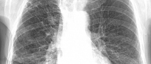 Хроническая обструктивная болезнь легких. Рекомендаций GOLD 2017