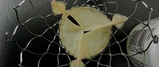 TAVR. Case report. Имплантация клапана Corvalve