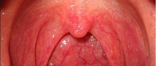 Острый фарингит. Руководство по диагностике и лечению