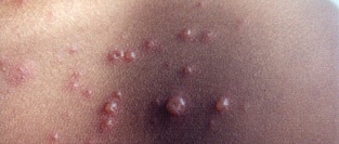 Ветряная оспа (ветрянка). Характеристика сыпи.