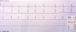 Фибрилляция предсердий, экстракардиальные операции и риск инсульта
