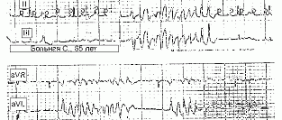 VANISH. Рецидивы желудочковой тахикардии. Аблация или амиодарон