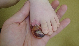 Герпетический панариций. Двенадцатый день болезни