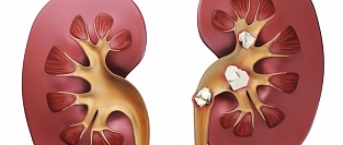 Мочекаменная болезнь. Вторичная профилактика