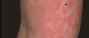 Крапивница. Описание элементов сыпи.