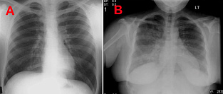 Пневмония. Информация для пациентов