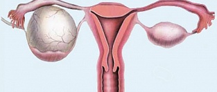 Гигантские кисты обоих яичников. Case report.