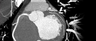 Сахарный диабет и скрининговая КТ-ангиография коронарных артерий. Обосновано ли использование?