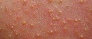 Транзиторный неонатальный пустулярный меланоз