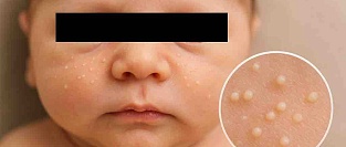 Милии (просянки). Как выглядят. Описание сыпи