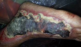 Варфариновый некроз кожи