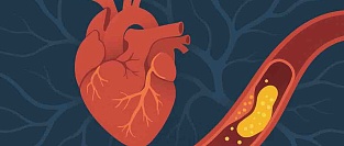 Дислипидемия. Рекомендации ESC/EAS 2025