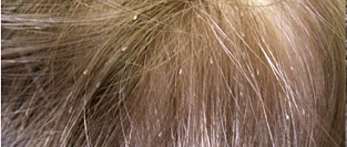 Педикулез. Лечение и профилактика