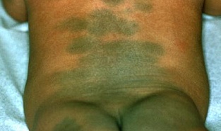 Монголоидные пятна у детей