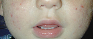 Детские акне