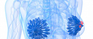 Атипичная гиперплазия и риск рака молочной железы