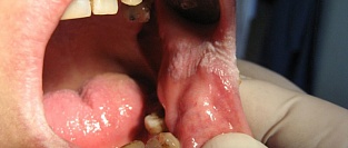 О профилактике мукозита полости рта после химиотерапии