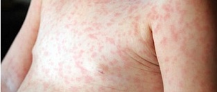 Сыпь у детей.