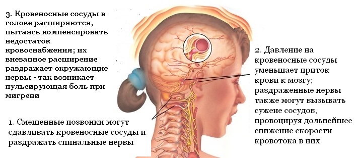 мигрень мигрень